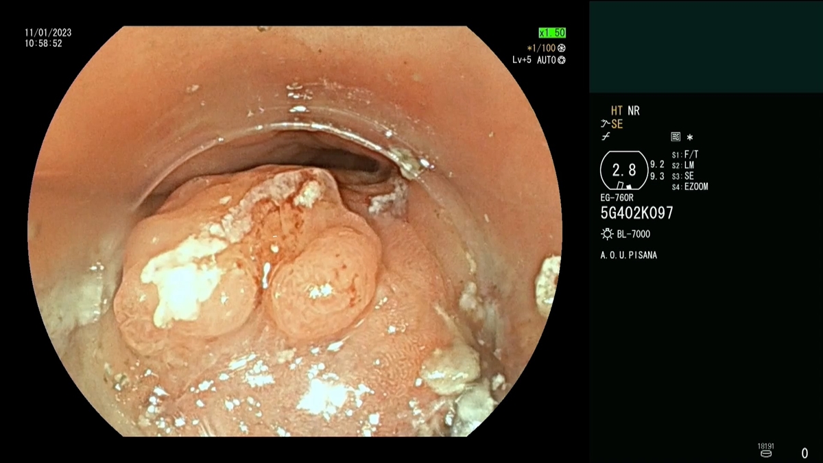 Dissezione sottomucosa esofagea per  tumore T1a (m2) dell'esofago